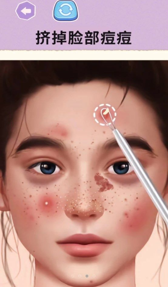 挤痘大师3
