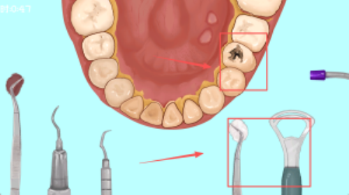 沉浸式牙齿清洁