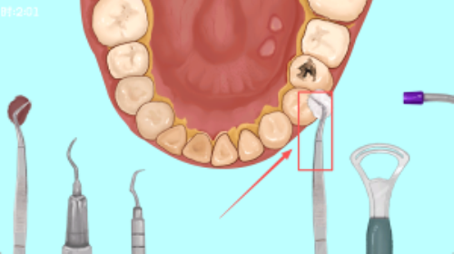 沉浸式牙齿清洁
